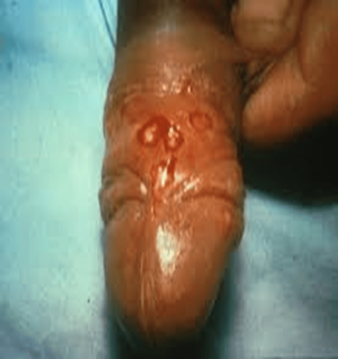 <p>chancre is painless, single, firm; non itchy ulceration/clean base, TX pcn</p>