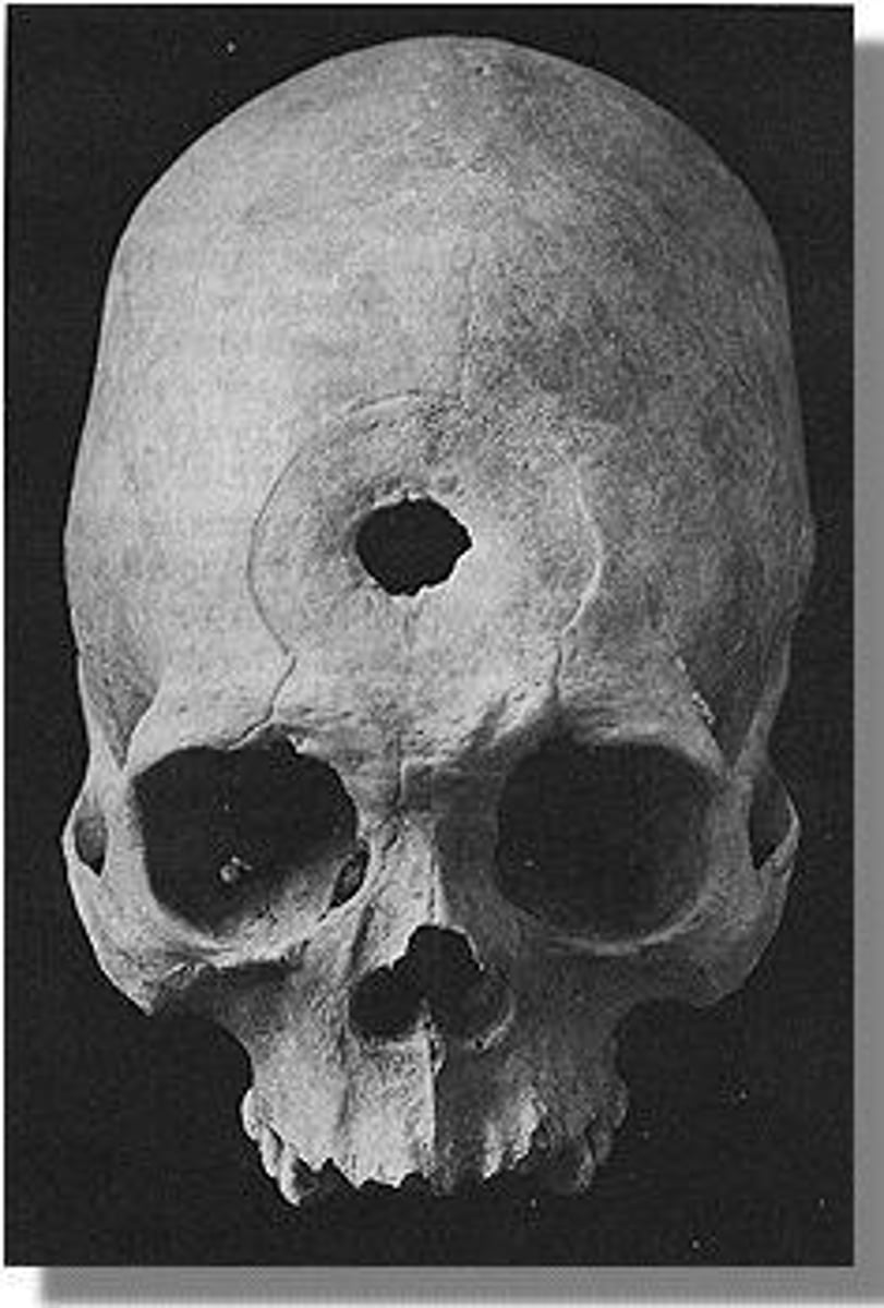 <p>A historical treatment method involving drilling a hole in the skull to release spirits.</p>
