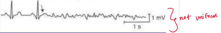 <p>What rhythm is present on the ECG?</p>