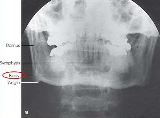 <ul><li><p>shows mandibular body</p></li><li><p>no rotation or tilt</p><ul><li><p>symmetric mandibular body</p></li><li><p>MSP of head aligned with long axis of collimated field</p></li></ul></li></ul><p></p>