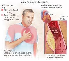 <p><strong>Unstable angina, non-ST-segment elevation myocardial infarction (NSTEMI), and ST-segment elevation myocardial infarction (STEMI)</strong></p><ul><li><p><strong>Unstable Angina</strong>: <strong>Chest pain<u> at rest</u> due to reduced blood flow to the heart.</strong></p></li><li><p><strong>NSTEMI</strong>:<strong> Partial blockage </strong>of a coronary artery causing heart muscle damage.</p></li><li><p><strong>STEMI</strong>: <strong>Complete blockage</strong> of a coronary artery leading to significant heart muscle damage.</p></li></ul>