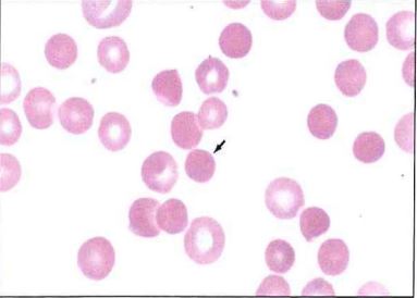 <p>The abnormal erythrocyte in the center of this image (arrow) may result from which of the following processes?</p><p>a deficiences of cellular membrane proteins</p><p>b absence of plasma lipoproteins</p><p>c defects in the cellular lipid bilayer</p><p>d deficiencies of cellular enyzmes</p>