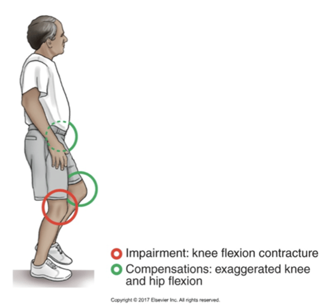 <p>•Knee Flexor Contracture Causing a Crouched Gait of the Stance Leg<br><br>•To clear the toes during swing, the unaffected contralateral limb must compensate with exaggerated knee and hip flexion</p>