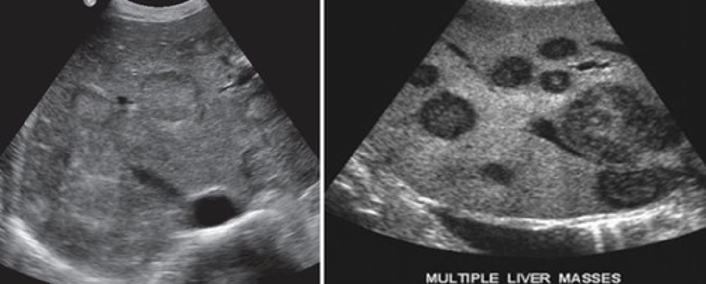 <p>Most common secondary liver cancer (more common than HCC)</p><p>Presents as multiple lesions througout the liver</p><p>Can have bullseye or halo sign</p>