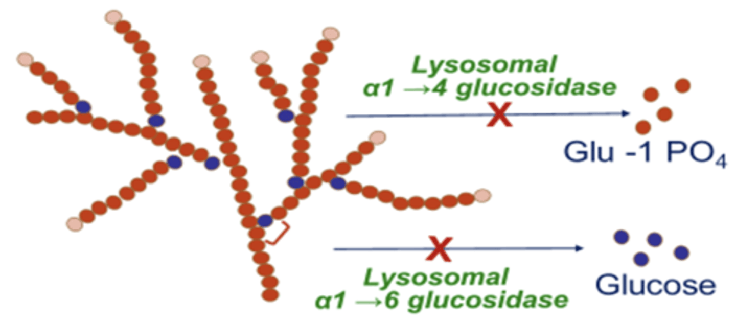 <p>inborn lisoosmal enzyme defect in liver, heart, and muscle</p><p>- accmulation of glycogen in lysosomes</p><p>- muscle hypotonia</p><p>- massive cardiomegaly due to thickening of heart muscles</p><p>- affects pumping of blood; death from heart failure by age 2</p>