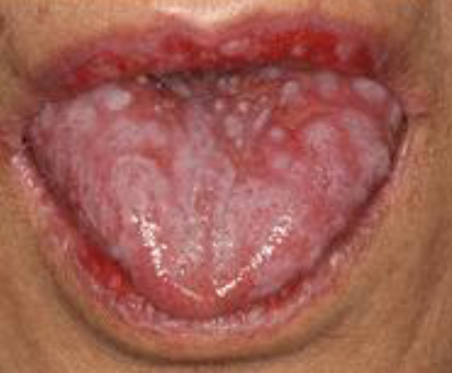 <p>lesion with lichenoid features, occurs after transplant </p>