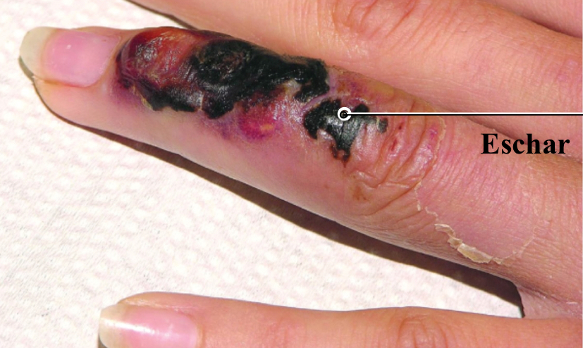 <p><span><span>Agent: Bacillus anthracis</span></span></p><p><span style="background-color: transparent;"><span>Bacteria usually shed from an animal makes its way to broken skin; results in </span><strong><span>eschars</span></strong><span> or swollen, black, crusty ulcers</span></span></p>