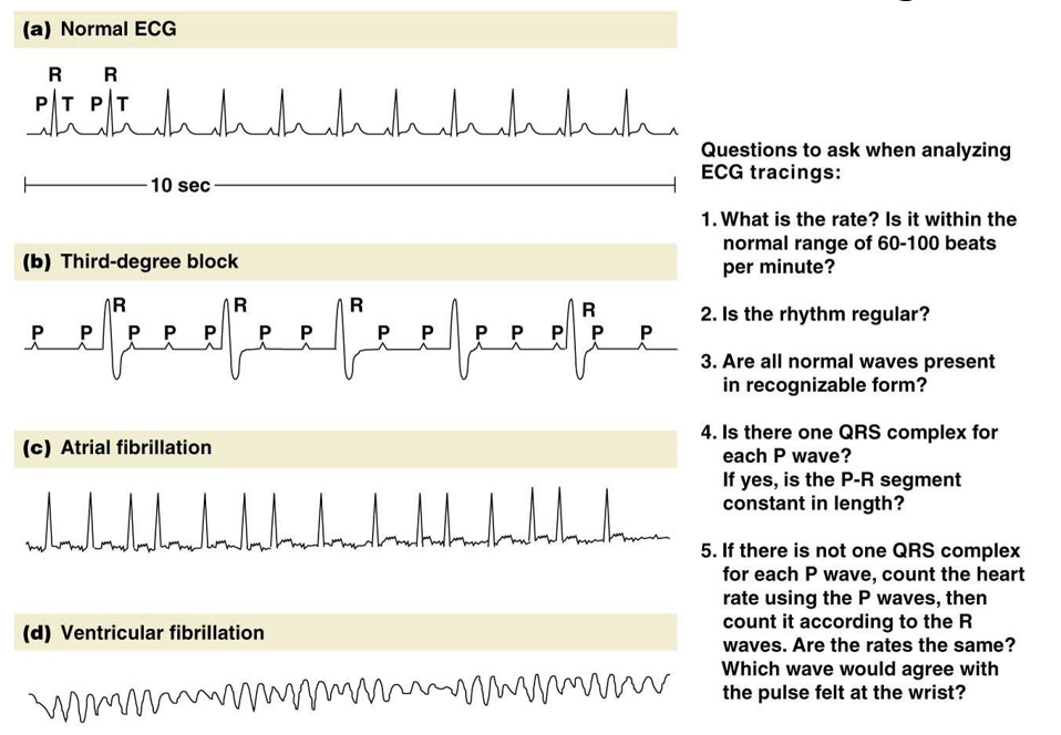 <p><u>abnormal ECG</u></p><ul><li><p><strong>3rd degree block</strong>: SA fires normally, ventricles don’t get signal and fire spontaneously</p></li><li><p><strong>atrial fibrilation</strong>: atria contract non-synchronously, not life-threatening</p></li><li><p><strong>ventricular fibrilation</strong>: ventricles contract non-synchronously, life-threatening</p></li></ul><p></p><p>pulse felt at wrist = R waves, heart rate = P waves</p>