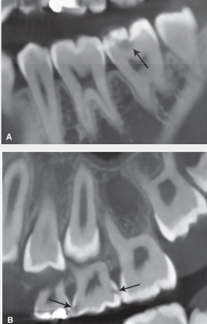 <ul><li><p><span style="color: #000000">Many studies show CBCT caries detection rates are approximately equivalent to intraoral modalities for non-restored teeth</span></p></li><li><p><span style="color: #000000">Beam-hardening and streak artefacts from metal objects are limiting factors</span></p></li><li><p><span style="color: #000000">Use of CBCT solely for purpose of caries detection is discouraged and not evidence based</span></p><ul><li><p><span style="color: #000000">Increased patient dose and cos</span></p></li></ul></li></ul><p></p>