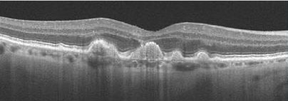 <p>The OCT would show accumulation of Drusen between the RPE and Bruch’s membrane at the fovea, visualised as bulging of the membrane with the bright white RPE rippled as a result. </p>