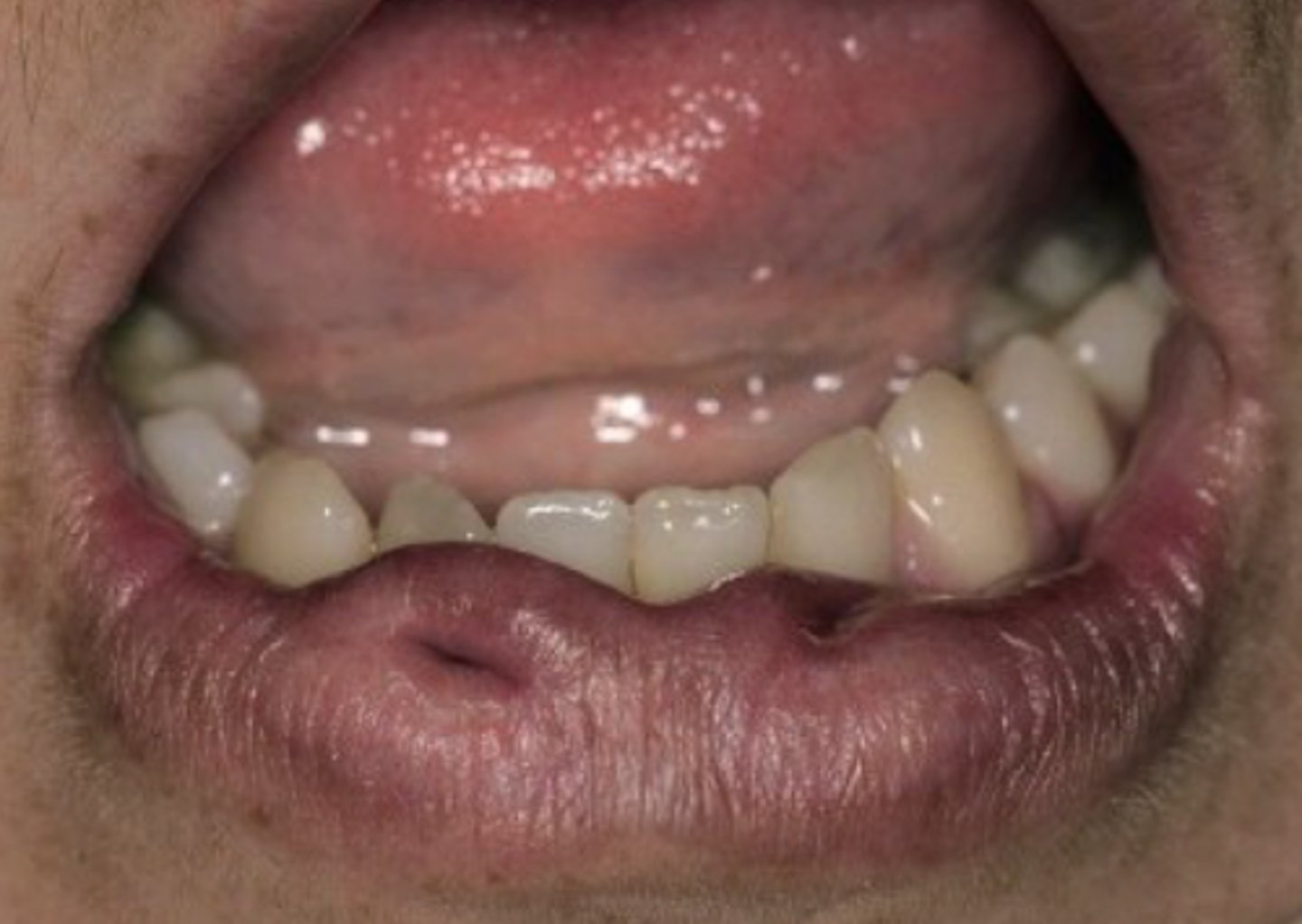 <p>• Rare congenital invaginations of</p><p>the lower lip</p><p>• Bilateral and symmetric</p><p></p><p>Could be part of van der Woude or kabuki syndrome </p>