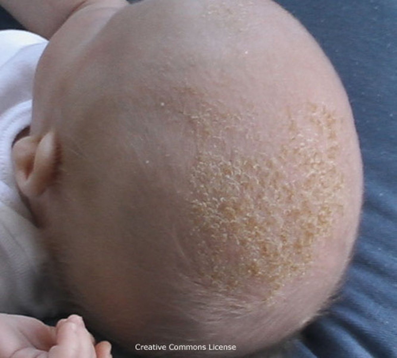 <p>"thick, yellow/white oily scale on an inflammatory base".</p><p>What to do? Gently clean w/ mild shampoo</p>