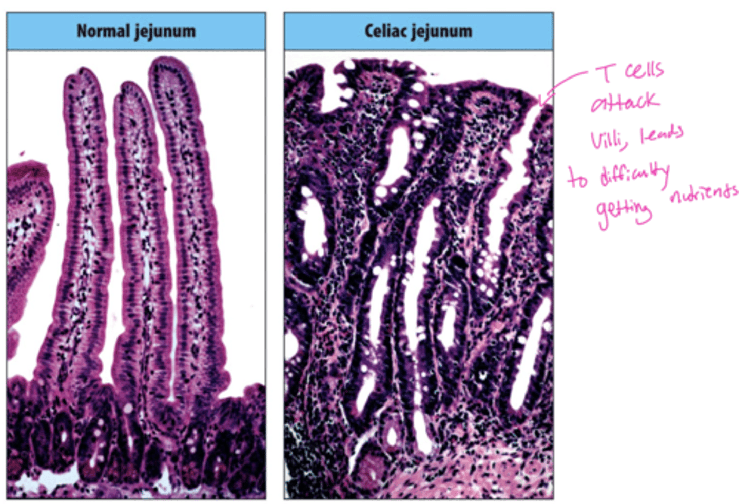 <p>A: Type IV (cell-mediated) hypersensitivity.</p><p>its an autoimmune disease, but only happens when triggered by the gluten peptide</p>