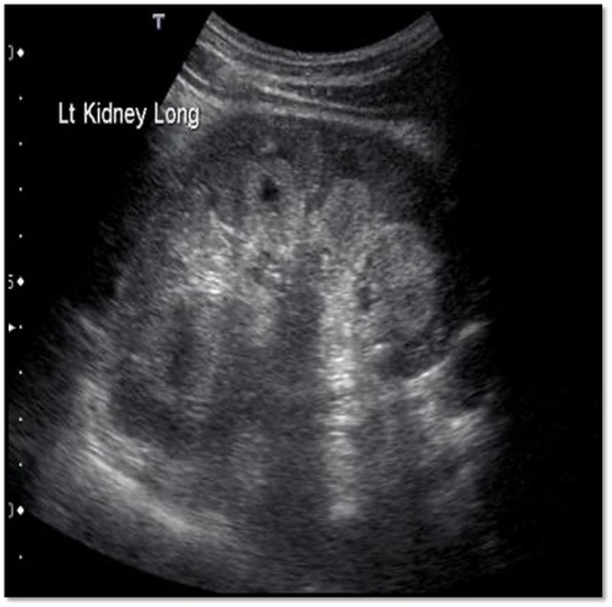 <p>MSK is a development anomaly that occurs in the medullary pyramids and consists of ___ dilation of the distal collecting ___ </p>