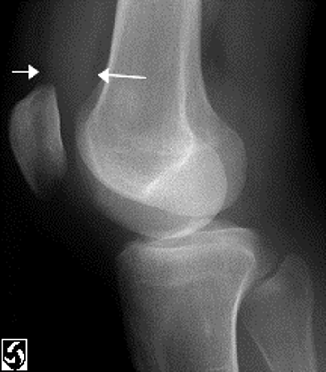 <p><strong>_____________</strong> is best seen on a <strong><span style="text-decoration:underline">lateral view</span> superior to the</strong> <strong>patella</strong> and <strong><span style="text-decoration:underline">anterior to the femur</span></strong></p>