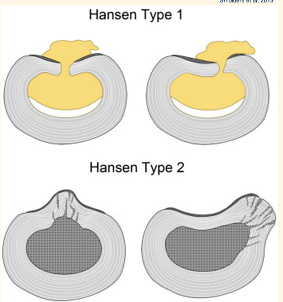 <p><u>Hansen </u><mark data-color="red" style="background-color: red; color: inherit"><u>type I</u></mark><u> : Intervertebral disc </u><strong><u>extrusion (IVDE)</u></strong></p><ul><li><p><u>Complete rupture of the annulus fibrosus</u></p><ul><li><p><strong>spilling-out</strong> of the nucleus pulposus into the vertebral canal</p></li></ul></li><li><p>Chondrodystrophic breeds : frenchies, daschund</p></li><li><p>early as &lt; 1 year old</p></li><li><p>acute onset histological degenerative</p></li></ul><p><u>Hansen</u><mark data-color="yellow" style="background-color: yellow; color: inherit"><u> type II</u></mark><u>: Intervertebral disc </u><strong><u>protrusion (IVDP)</u></strong></p><ul><li><p><u>Fissures form in the annulus fibrosus</u></p><ul><li><p><strong>bulging</strong> of the annulus fibrosus and nucleus pulposus</p></li></ul></li><li><p>Non-chondrodystrophic breeds </p></li><li><p>Older &gt; 5 years</p></li><li><p>Chronic, more slowly progressive onset</p></li></ul><p></p>