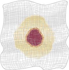 <p><u><span>Bleeding From the Nose, Ears, and Mouth Cont’d</span></u></p><ul><li><p><span style="font-family: "Times New Roman";"><span>Bleeding from the nose or ears following a head injury:</span></span></p><ul><li><p><span style="font-family: "Times New Roman";"><span>May indicate a skull —</span></span></p></li><li><p><span style="font-family: "Times New Roman";"><span>May be —- to control</span></span></p></li><li><p><span style="font-family: "Times New Roman";"><span>Do not attempt to —- blood flow.</span></span></p></li><li><p><span style="font-family: "Times New Roman";"><span>— cover the bleeding site with a sterile gauze pad.</span></span></p></li><li><p><span style="font-family: "Times New Roman";"><span>Apply —- compression with a dressing.</span></span></p></li></ul></li><li><p><span style="background-color: aqua; font-family: "Times New Roman";"><mark data-color="yellow" style="background-color: yellow; color: inherit;"><span>A </span></mark><strong><mark data-color="yellow" style="background-color: yellow; color: inherit;"><span>target or halo-shaped</span></mark></strong><mark data-color="yellow" style="background-color: yellow; color: inherit;"><span> stain may occur on the dressing if blood or drainage contains —- —-.</span></mark></span></p><ul><li><p><span style="font-family: "Times New Roman";"><span>Called the —- —-</span></span></p></li><li><p><span style="font-family: "Times New Roman";"><span>Can determine an — —- —</span></span></p></li><li><p><span style="font-family: "Times New Roman";"><span>CSF will move through gauze faster than blood because it's less dense</span></span></p></li><li><p><span style="font-family: "Times New Roman";"><span>You will see red dot in center and larger —- circle (CSF)</span></span></p></li></ul></li></ul><p></p>