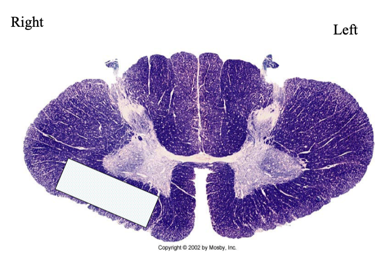 <p>Lesion Diagram: What would you expect to see on examination of this individual</p>