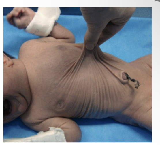 <p>What is Cutis laxa</p>