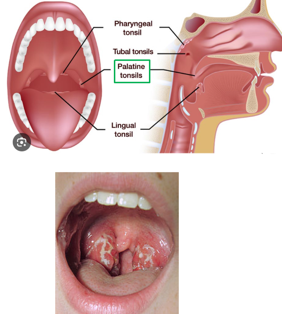 <ul><li><p>ring of lymphoid tissue around the entrance of the pharynx</p><ul><li><p>look like localized swellings of mucosa</p></li></ul></li><li><p>remove ingested/inhaled pathogens</p></li><li><p>PALATINE TONSILS are the largest and most often infected</p></li></ul><p></p>