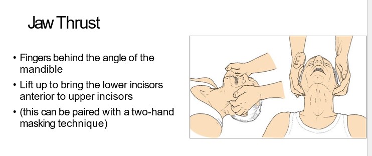   

•Fingers behind the angle of the  mandible

  

•Lift up to bring the lower incisors  anterior to upper incisors

  

•(this can be paired with a two-hand  masking technique)

  