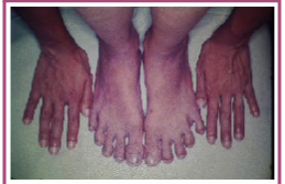 Refers to isolated cyanosis affecting the lower (but not the upper) extremities in the patient with a Large Patent Ductus Arteriosus and Secondary Pulmonary
hypertension with right-to-left shunting at the great vessels level