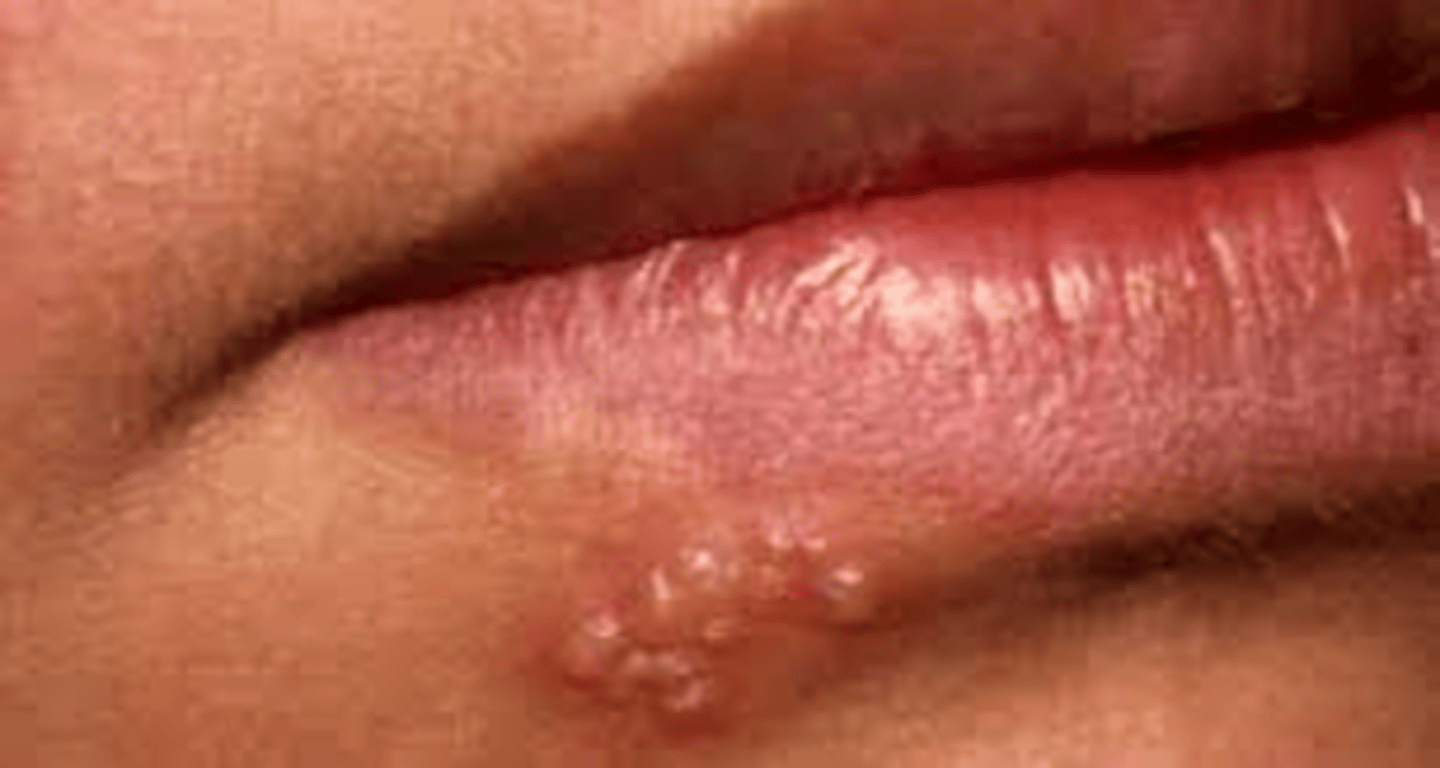<p>name this skin pathology</p>