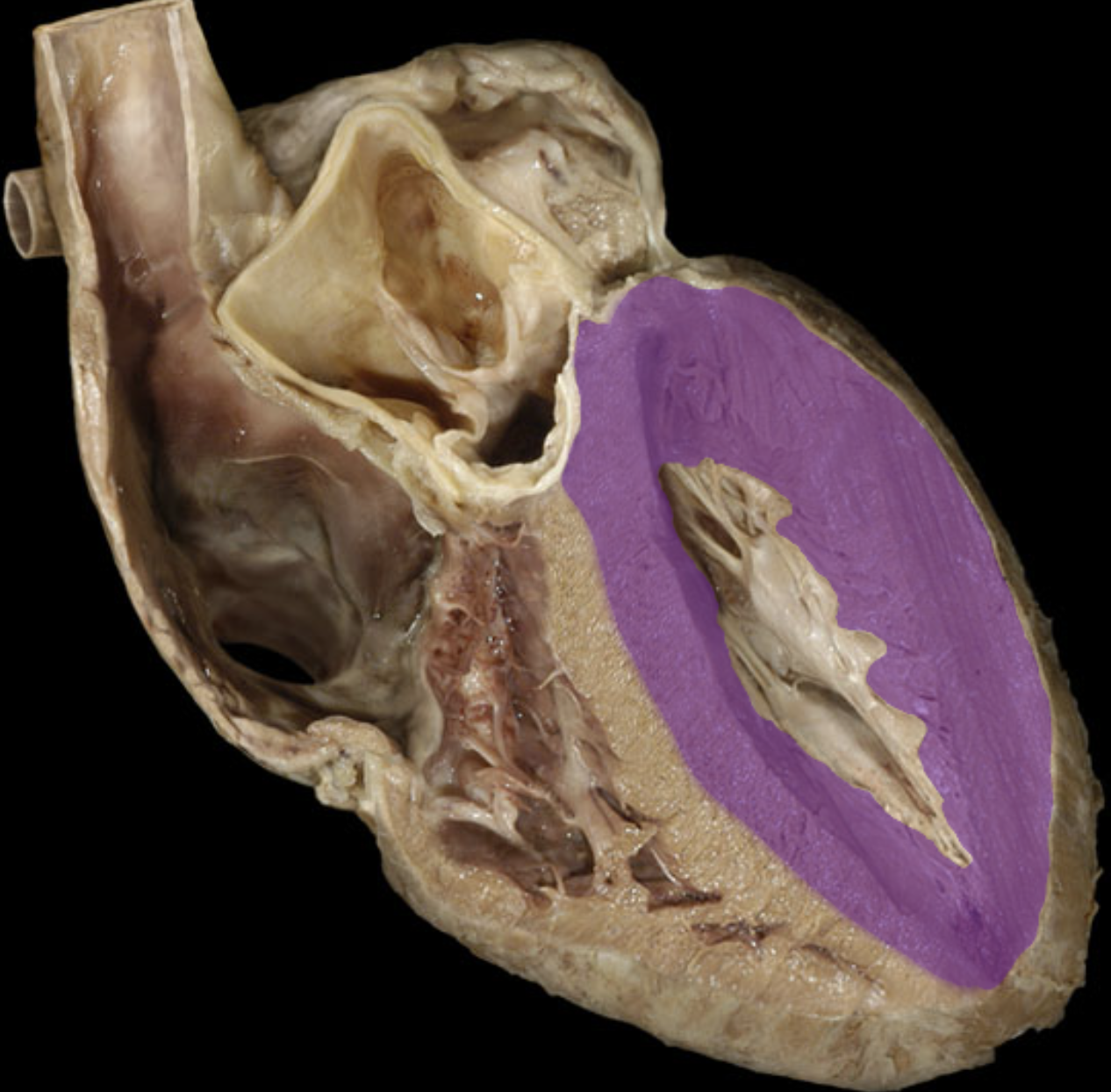 <p>Myocardium of left ventricle </p>