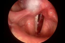 <ul><li><p>organic, structural</p></li><li><p>unilateral fluid-filled bump, like a blister</p></li><li><p>can form in one moment of voice use</p></li><li><p>voice isn’t clear, it’s breathy and there’s too much airflow</p></li><li><p>higher pitches are more difficult to produce</p></li></ul>