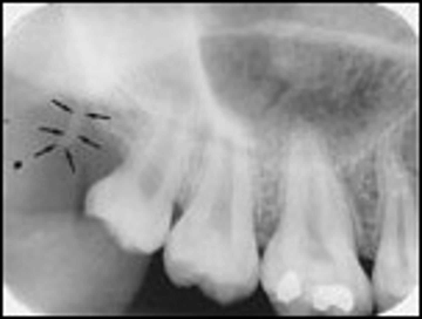<p>What is the radiopaque structure seen here?</p>