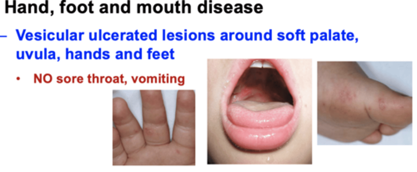 <p><span style="text-decoration:underline">Vesicular ulcerated lesions</span> around soft palate, uvula, hands and feet</p><p>•<strong>NO sore throat,</strong> vomiting</p>