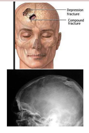 <p>Skull fx where the fragment is depressed in like a ping pong ball</p>