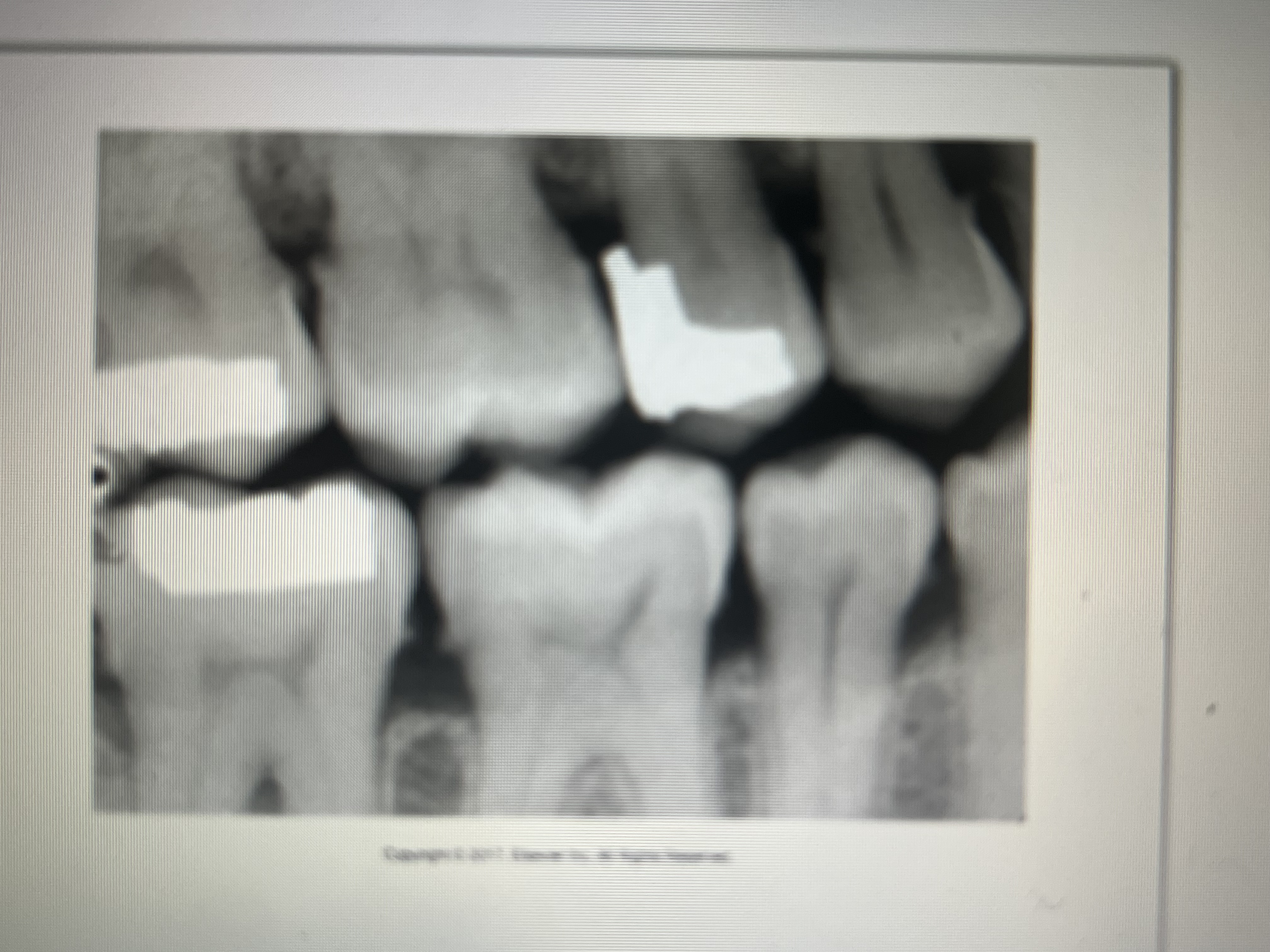 <p>Extensions of amalgam seen beyond the crown portion of a tooth in the interproximal region.</p>