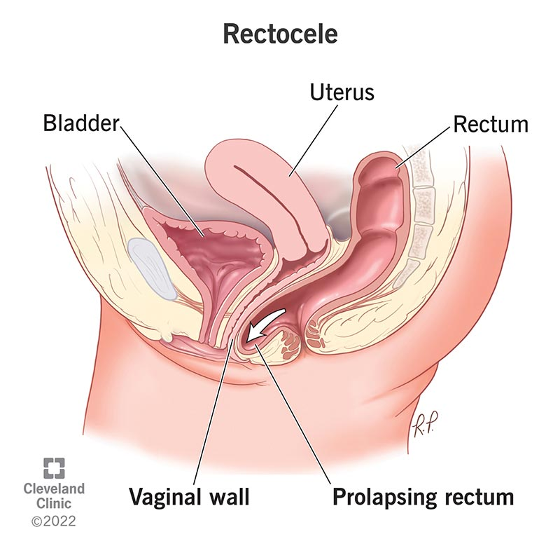 <ul><li><p>posterior wall of vagina becomes weakened &amp; thin</p></li><li><p>straining at defecation</p></li><li><p>digital pressure on posterior vaginal wall to facilitate BM</p></li></ul><p></p>