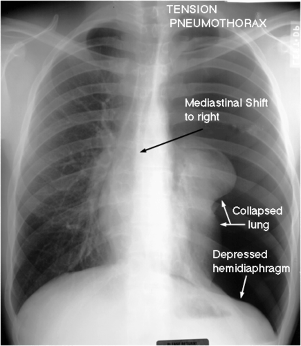<p>Tension pneumothorax</p>