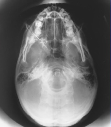 <p>What is this X-ray demonstrating?</p>