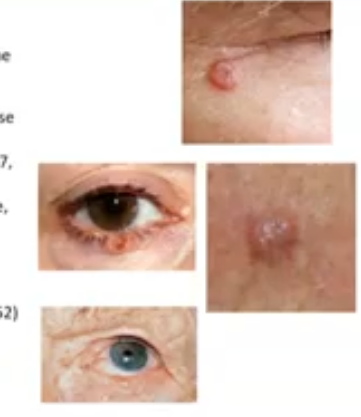 <p>basal cell carninoma </p>