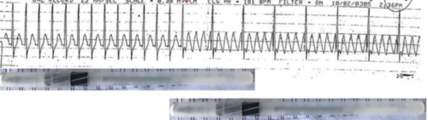 <p>What arrhythmia is this?</p>