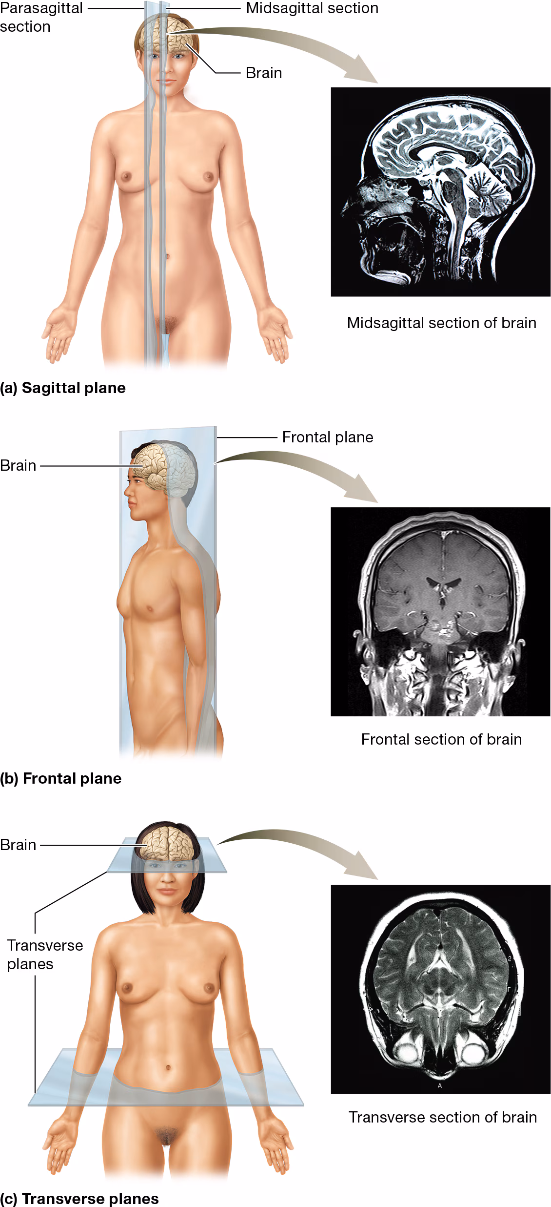 <p>AKA the coronal plane and it divides the body/body part into anterior and posterior sections</p><ul><li><p>easy to remember because the frontal plane gives a front section and back section</p></li></ul><p></p>