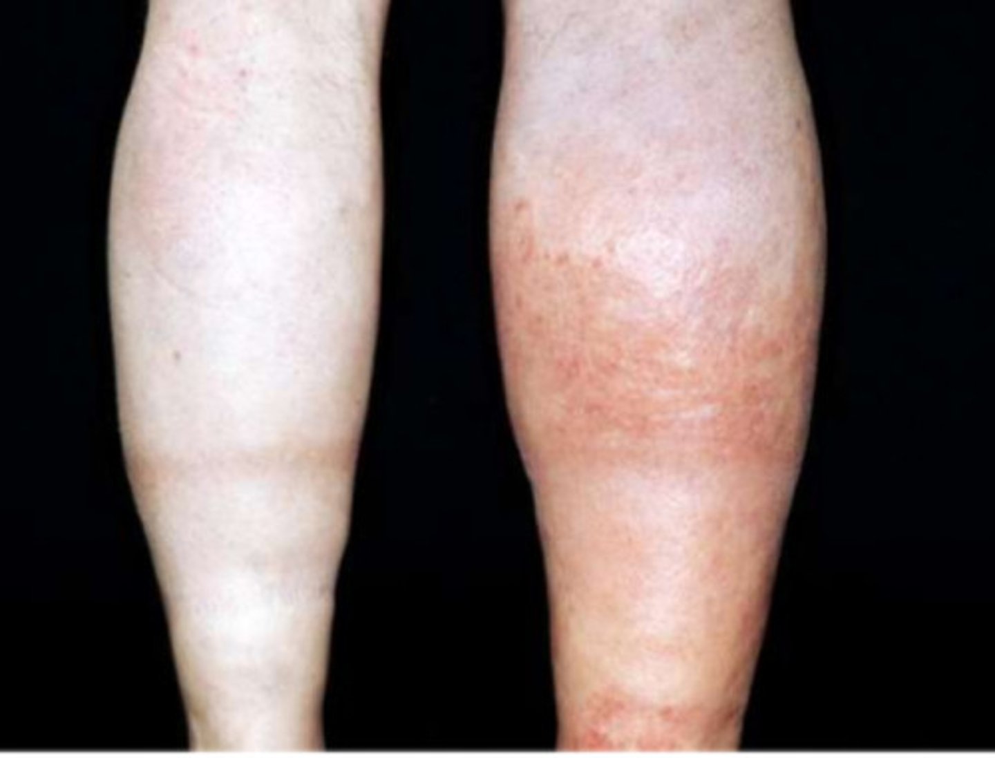 <p>- thromboembolism (DVT, PE)</p><p>- high risk in hip fractures, trauma (up to 60% of hip fracture patients)</p>