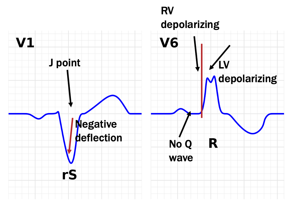 <p>QRS complex longer then 0.12 s in duration (3 small boxes)- best measured in V1</p><p>RS pattern in V1- find J, travel backwards, first deflection is negative</p><p>double QRS- notching of QRS in lateral leads (I, aVL, V5, V6) best seen in V6</p><p>lack of Q waves in lateral leads</p>