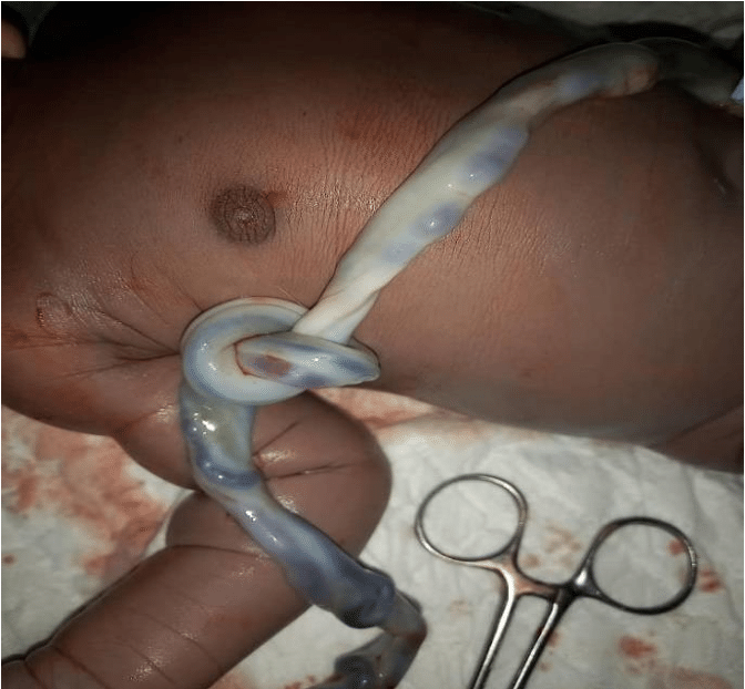 <p>True Umbilical Cord Knot (TUCK)</p>