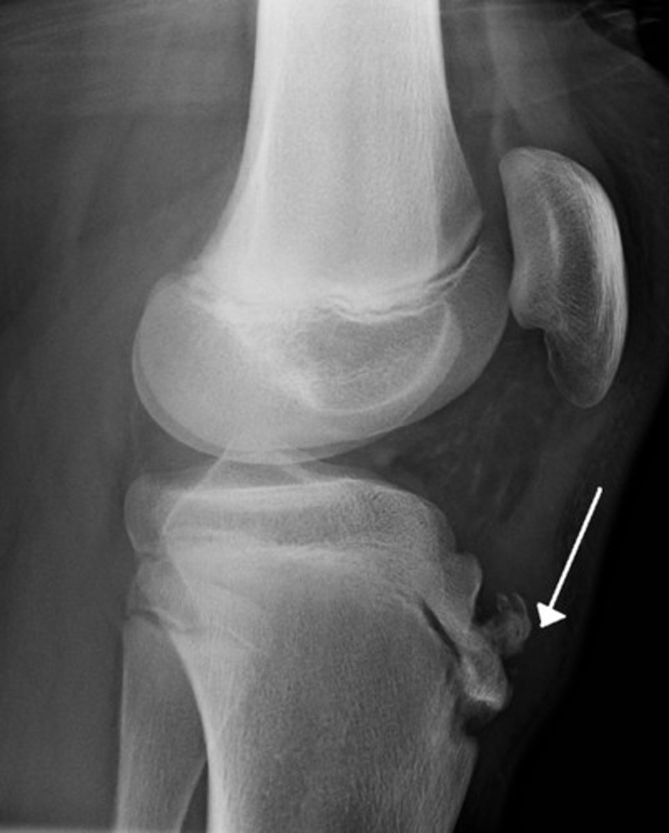 <p>osgood-schlatter*** → response to stress on tibial tuberosity</p>