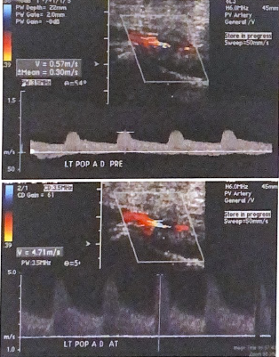<p>Calculate the Vr for the popliteal artery in these images, is there a hemodynamically significant stenosis in the left distal popliteal artery?</p>