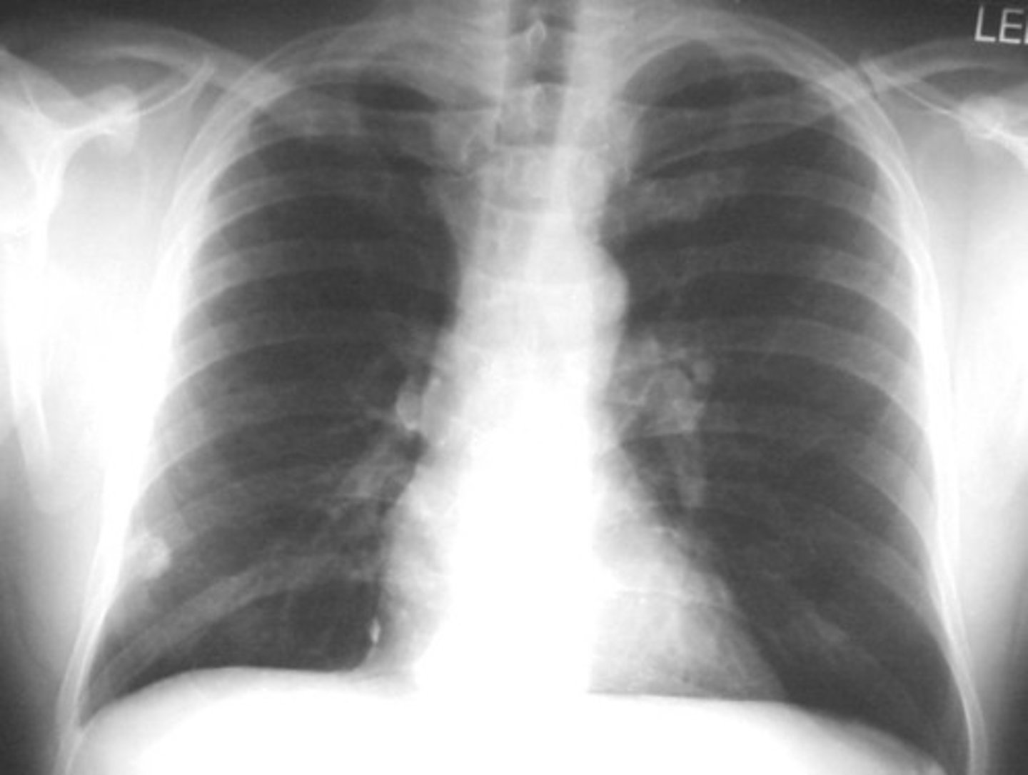 <p>- The development of a mass of cells that divides in an uncontrolled way, which is a tumour.</p><p>- Exposure to asbestos fibres, pollutants, and tobacco from smoking increases the risk for lung cancer.</p><p>- Begins in the walls of the air passages, usually the bronchi, and the inhaled particles constantly irritate the mucous membrane that lines the air passages.</p><p>- This creates an excessive production of mucus, causing the cells at the base of the membrane to divide more rapidly. (The accumulation of mucus cannot be removed.)</p><p>- This results in 'smokers cough', and the trapped mucus causes the alveoli to rupture. -&gt; Emphysema -&gt; Cancer in the air passages can travel around the body.</p>