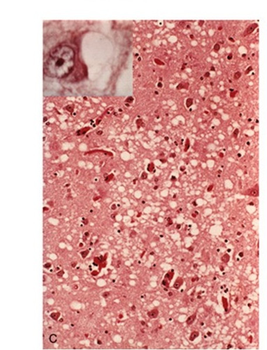 <p>Define Condition:</p><p>-Prion Disease (Transmissible spongiform encephalopathy)</p><p>-Over 70 y/o</p><p>-Causes rapidly progressive dementia with initial myoclonus and gait abnormalities</p><p>-Duration = 1 yr (onset to death)</p><p>Dx:</p><p>-Microscopic spongiform change (cortex has holes in it)</p><p>-Neuron Loss</p><p>-No inflammation</p>