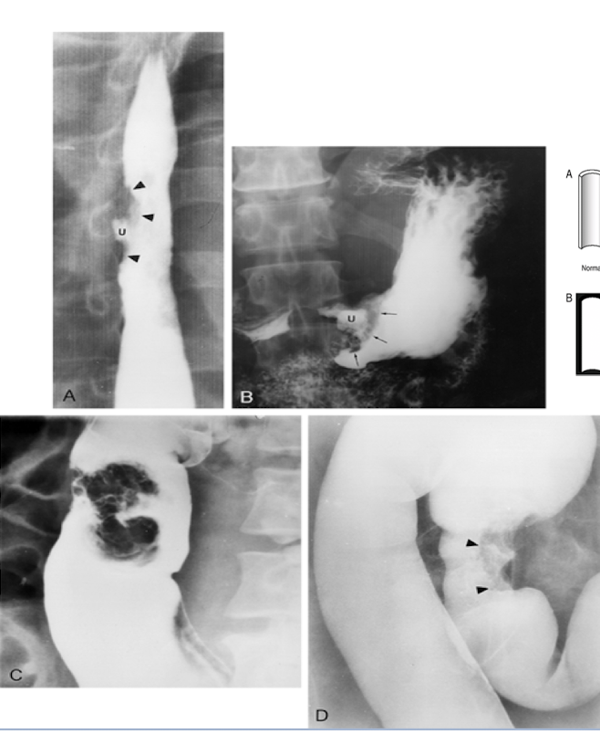 <p>What is D?</p><p>a. Mucosal mass</p><p>b. Diverticula</p><p>c. Pedunculated polyp</p><p>d. Sessile polyp</p>