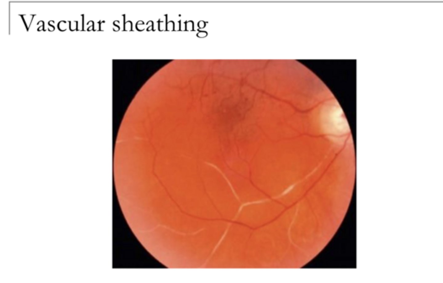 <p>EXAM QUESTION: </p><p>What does vascular sheathing result from?</p>