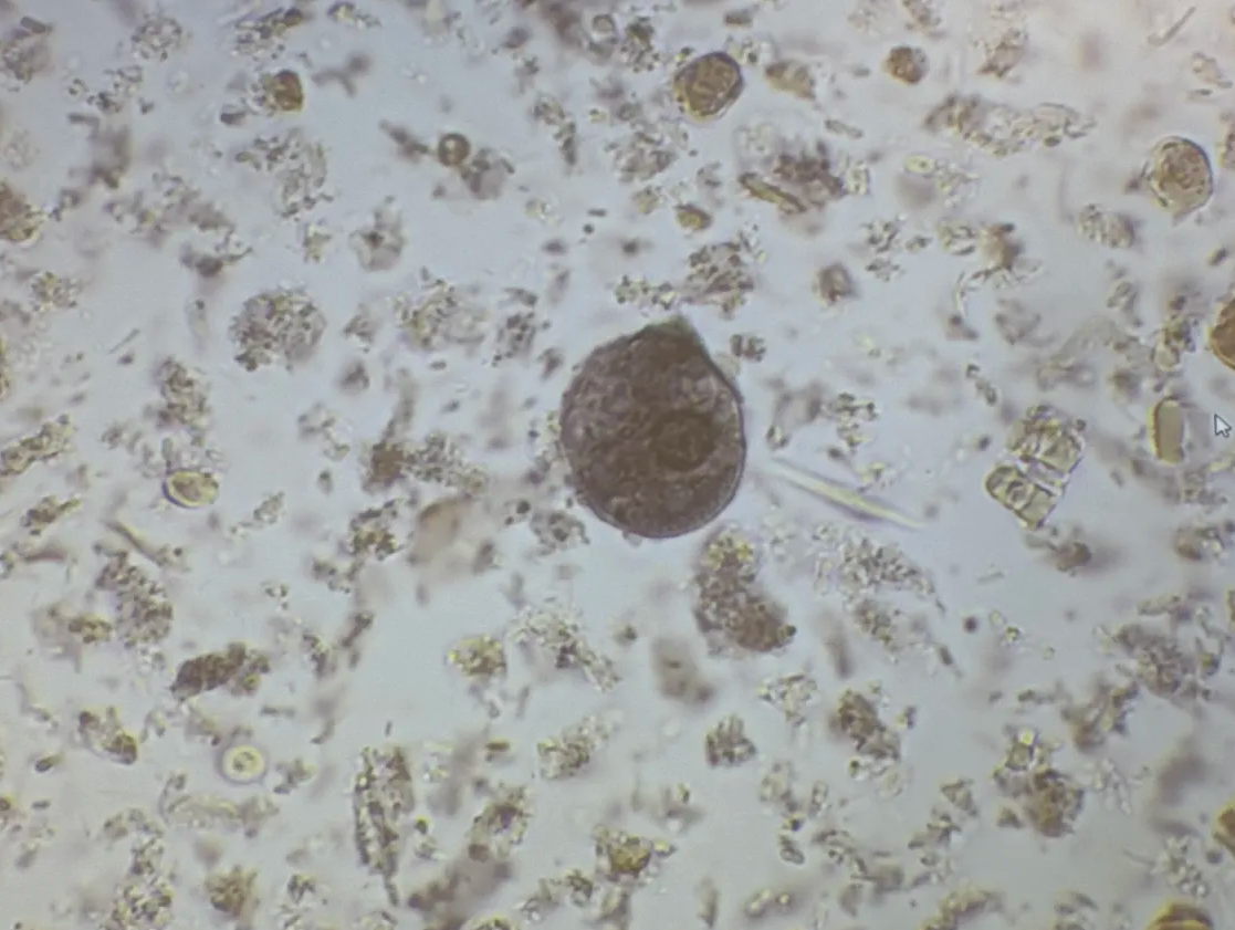 <p>human suffering from severe diarrhea</p><p>use fine focus to count nuceli</p>