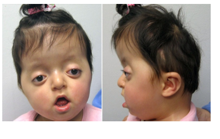 <ol><li><p>abnormally shaped head </p></li><li><p>wide set eyes </p></li><li><p>beaked nose </p></li><li><p>underdeveloped upper jaw </p></li><li><p>thumbs and big toes point away from other digits</p><ol><li><p>may hae webbing or fusion </p></li></ol></li><li><p><u>hearing issues D</u></p></li></ol><p></p>